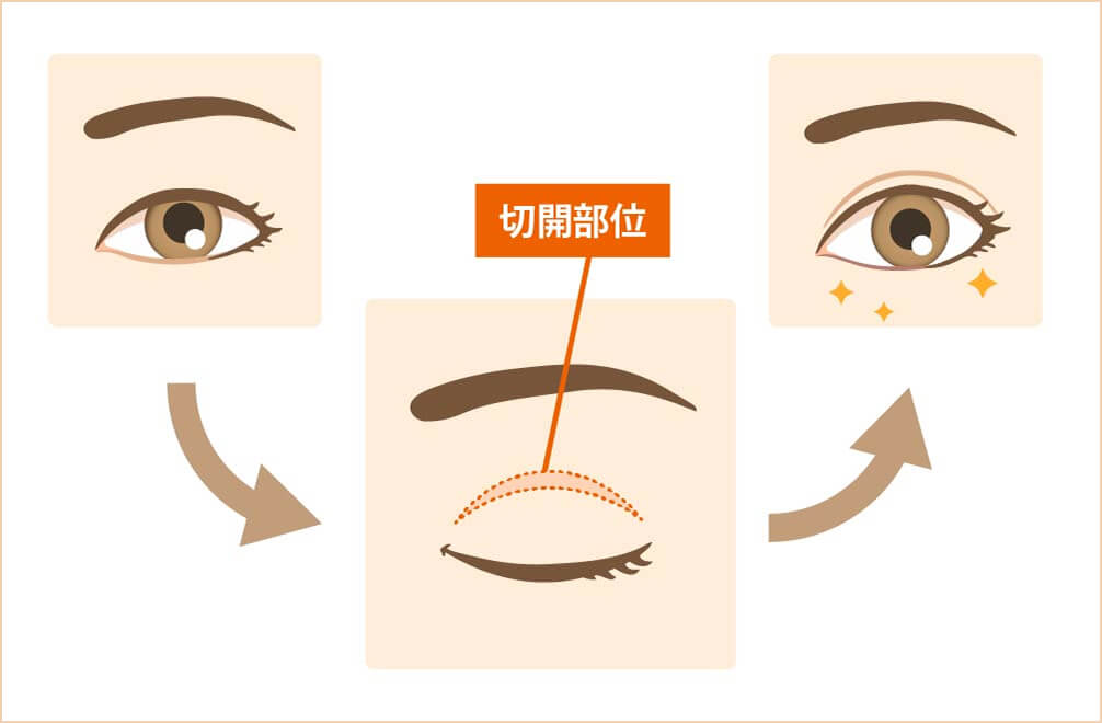 全切開二重術