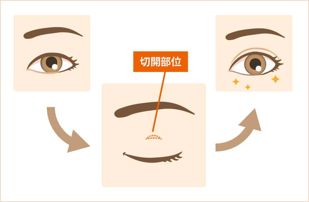 眉下切開術