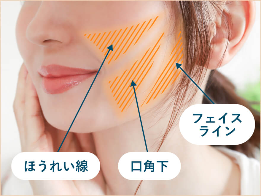ほうれい線、口角下、フェイスライン