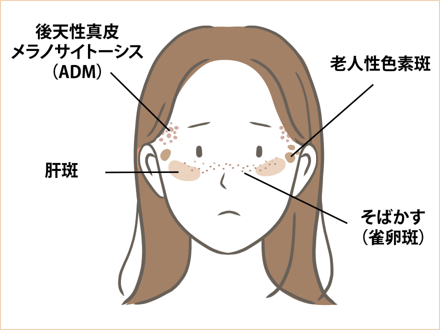 後天性真皮メラノサイトーシス(ADM)、肝斑、老人性色素斑、そばかす(雀卵斑)