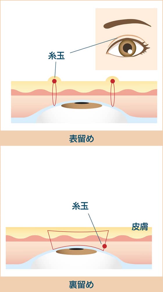 表留めと裏留め