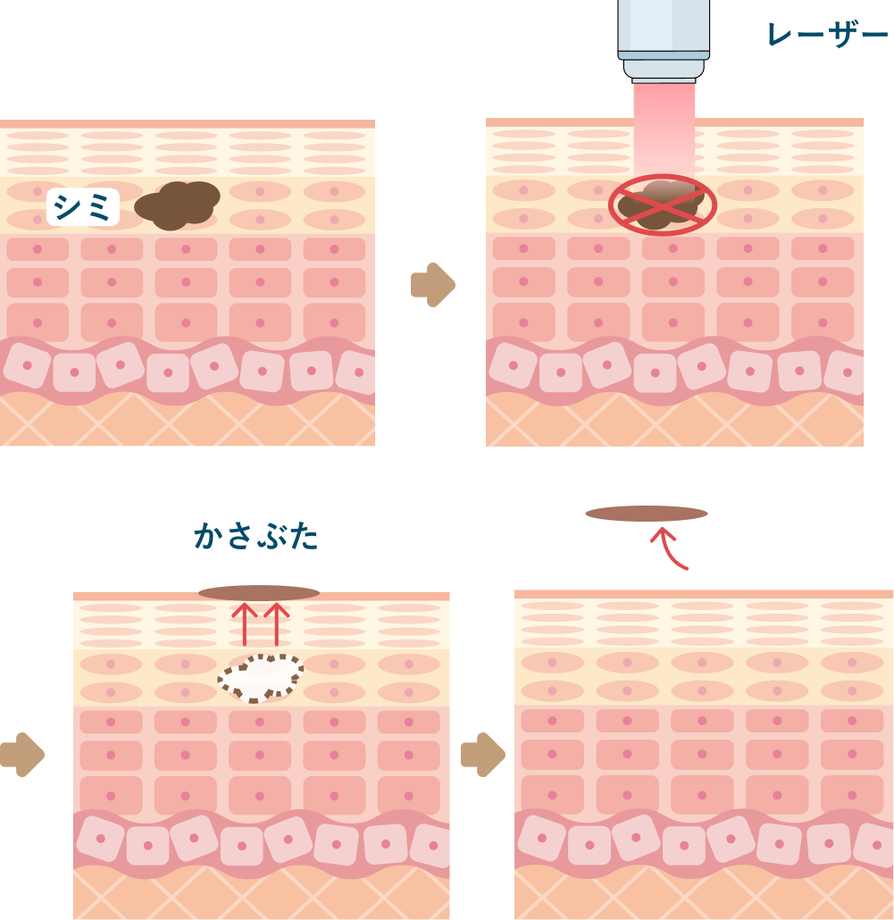 レーザーでシミが薄くなる仕組み