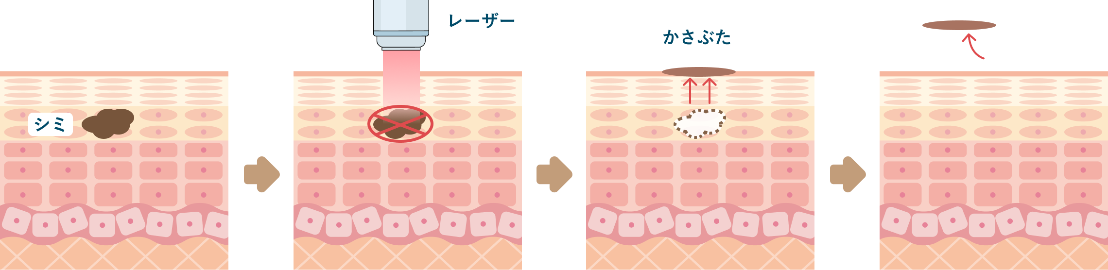 レーザーでシミが薄くなる仕組み