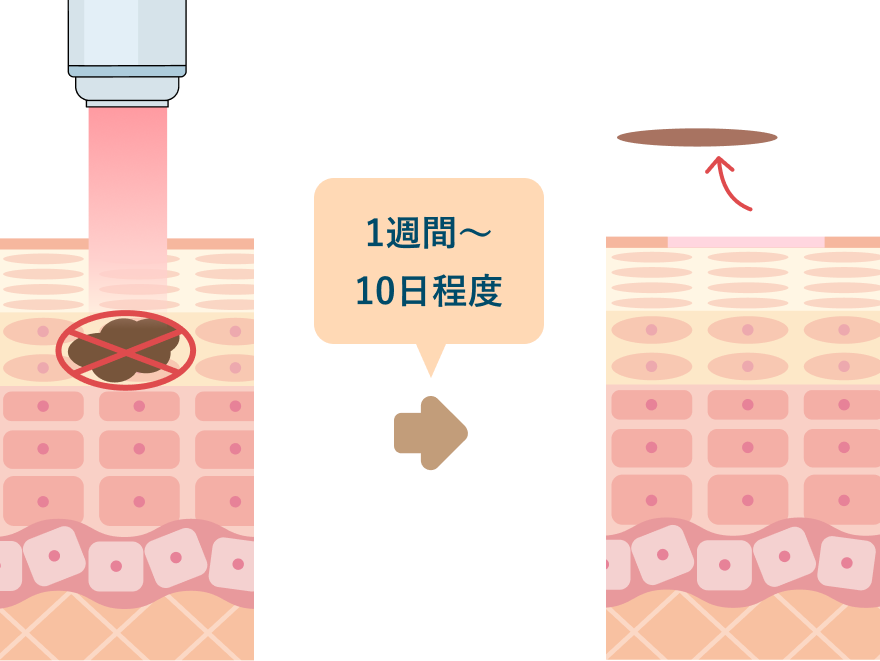 シミ取りレーザー治療