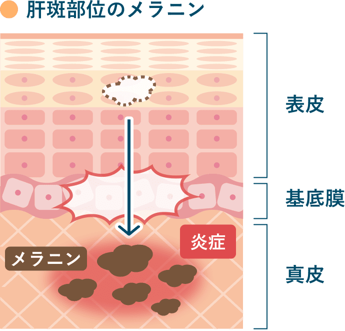 肝斑部位のメラニン