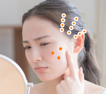 当院のニキビ跡治療 詳しくはこちら