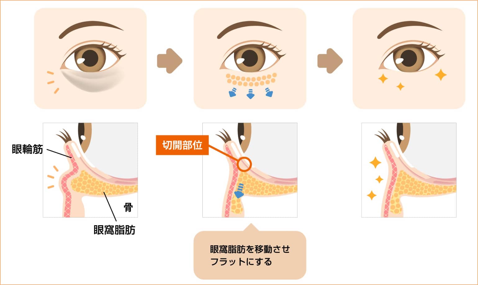 眼窩脂肪を移動させフラットにする