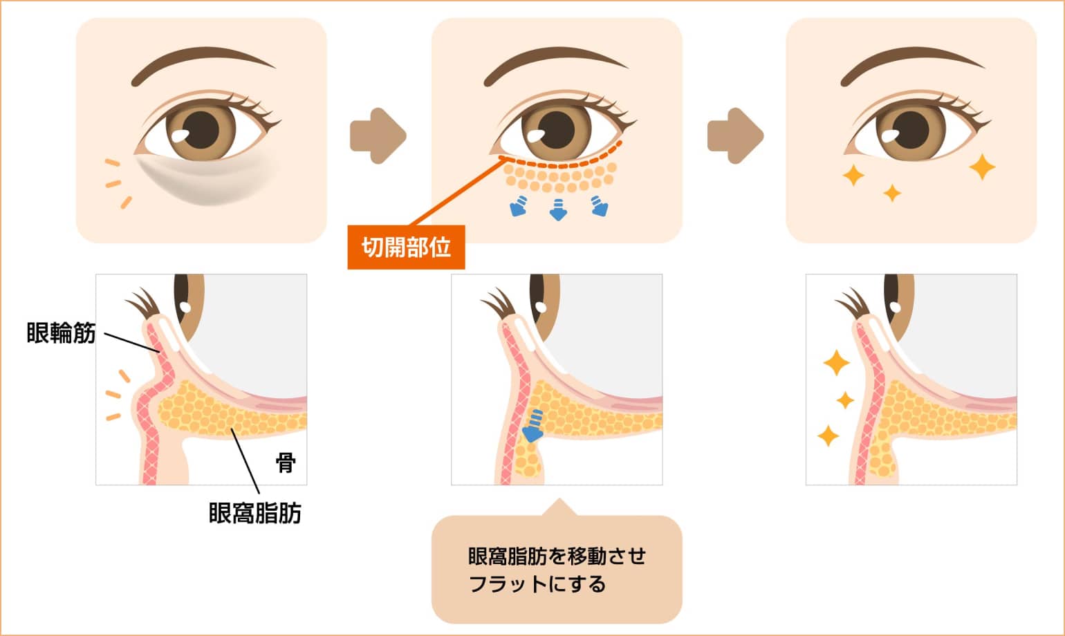 眼窩脂肪を移動させフラットにする