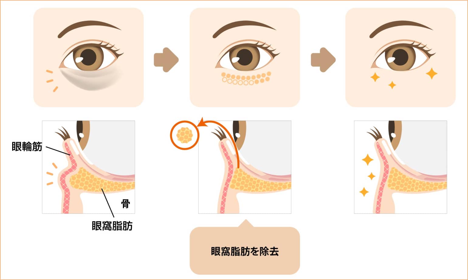 眼窩脂肪を除去
