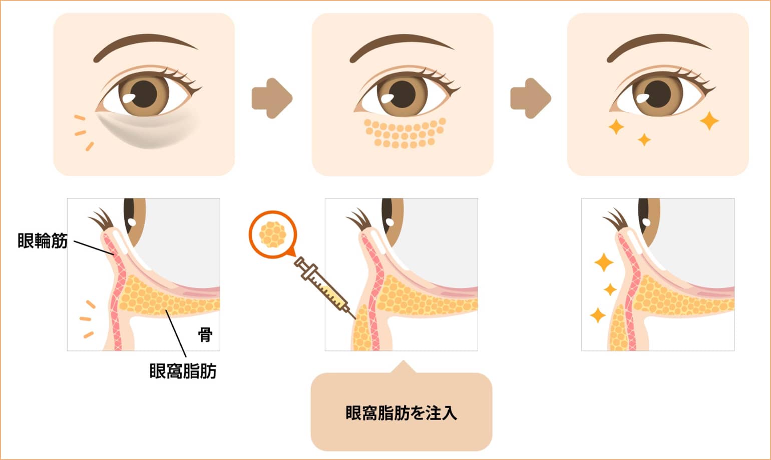 眼窩脂肪を注入