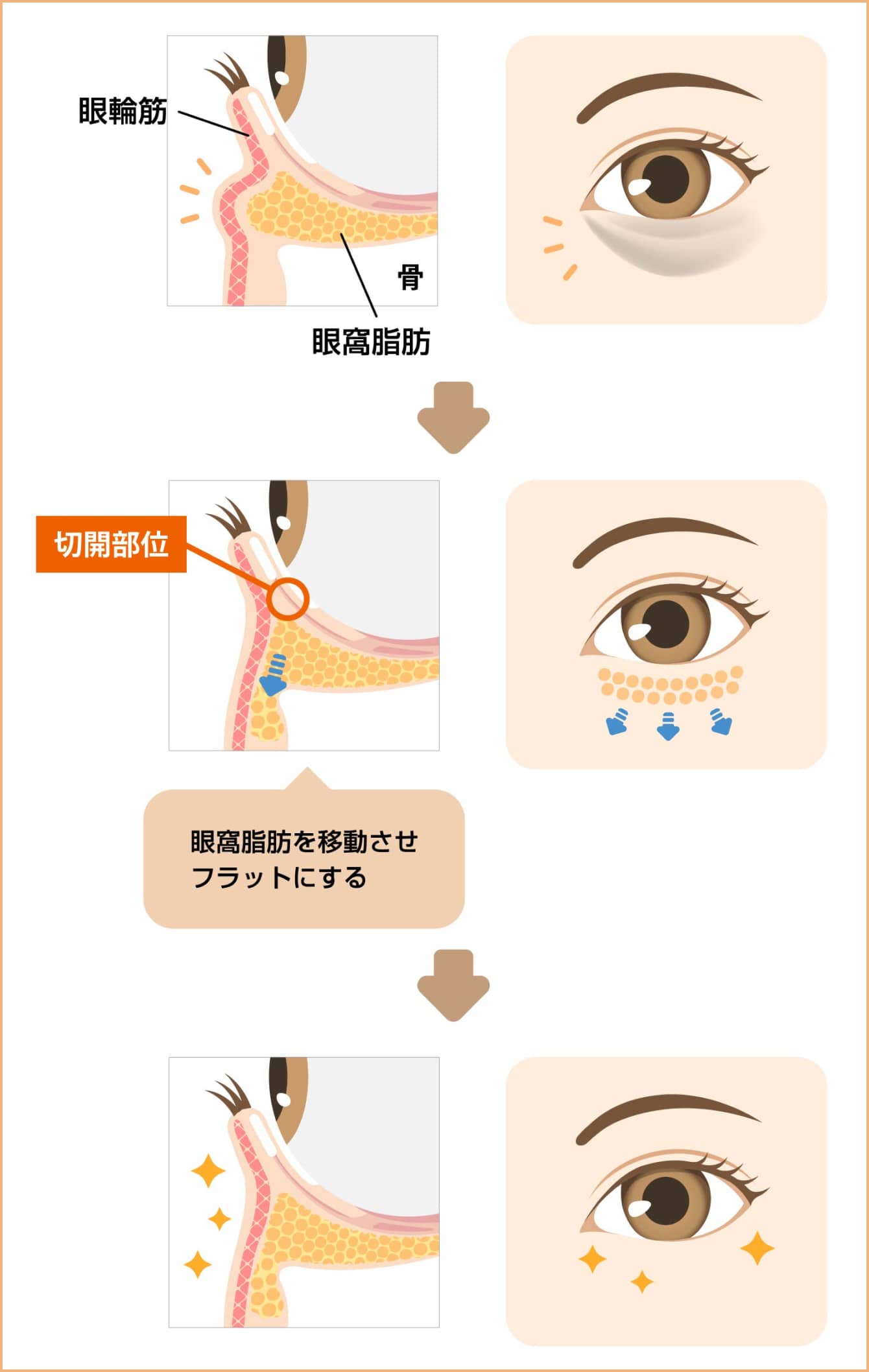 眼窩脂肪を移動させフラットにする
