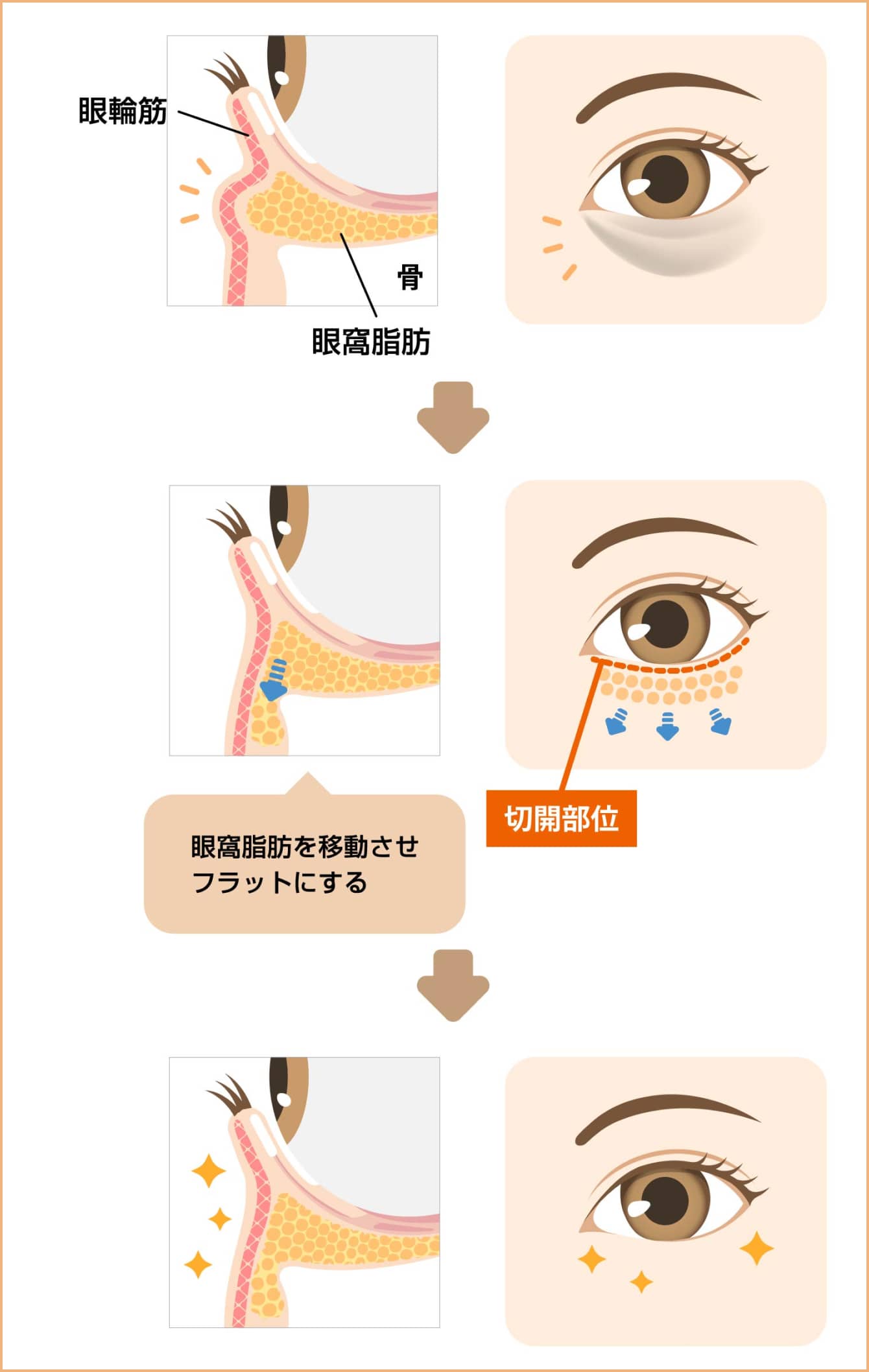 眼窩脂肪を移動させフラットにする