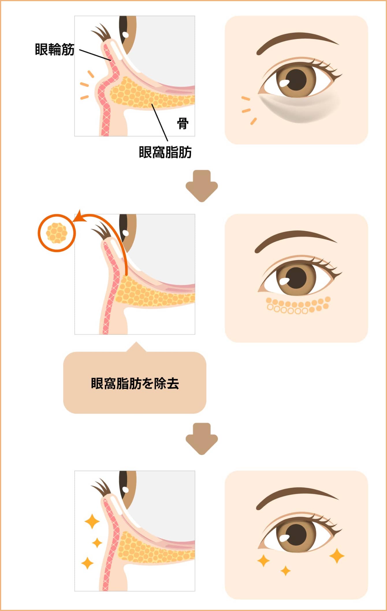 眼窩脂肪を除去