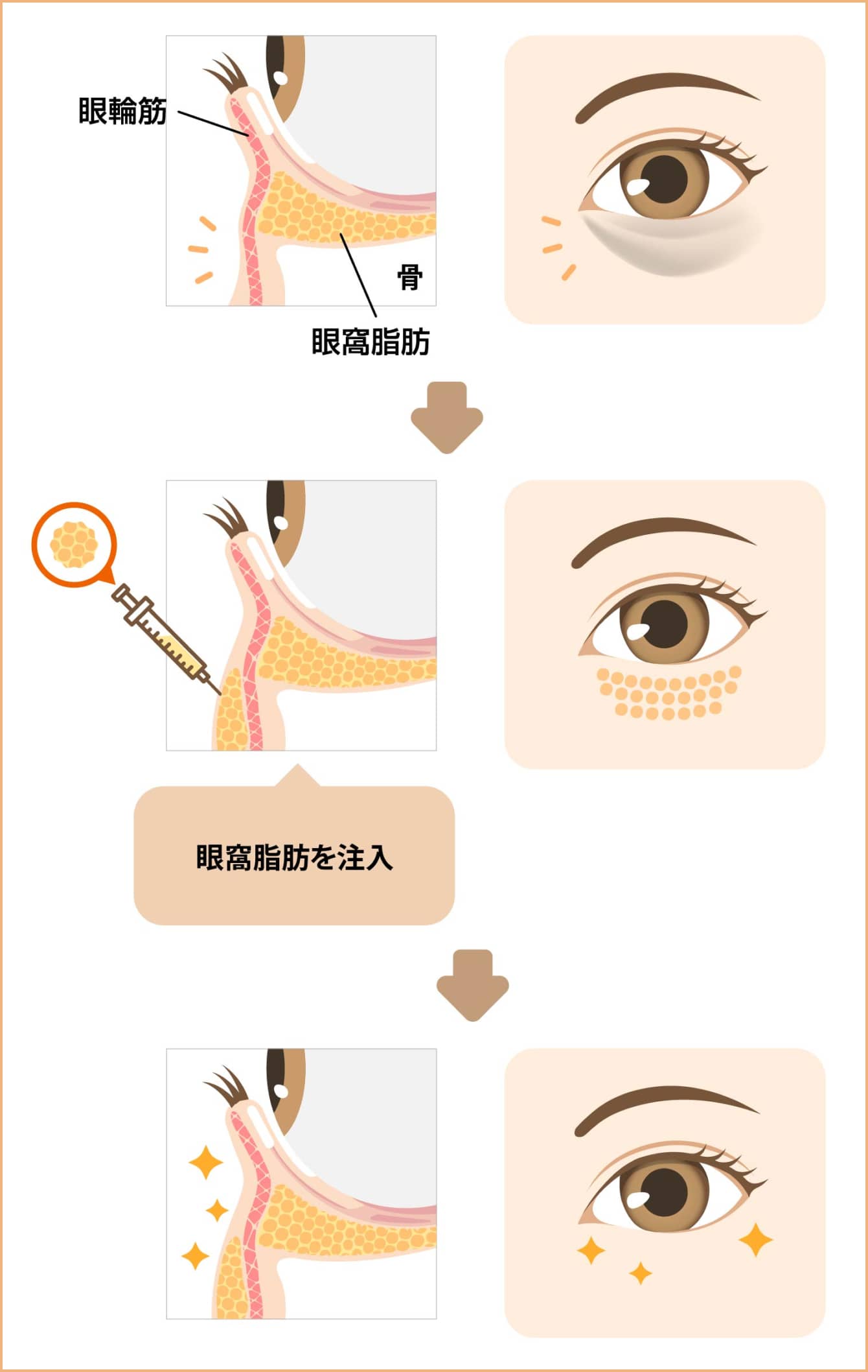 眼窩脂肪を注入